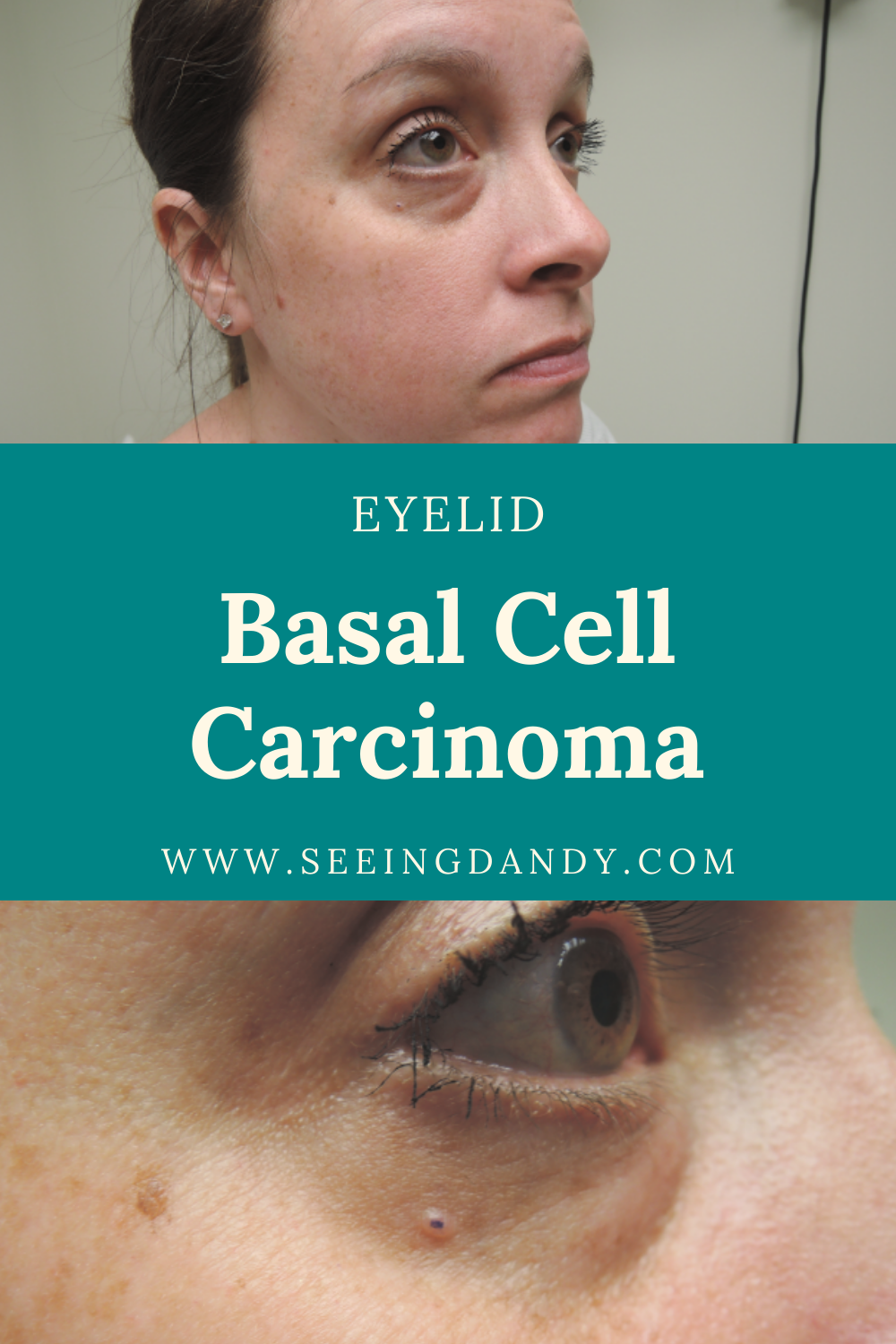 skin cancer, lower eyelid basal cell carcinoma, basal cell carcinoma, dermatology, mohs surgery
