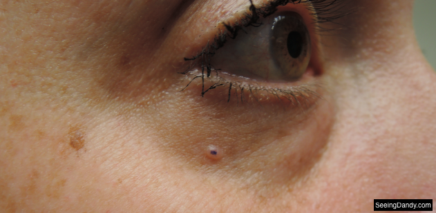 face skin cancer, lower eyelid basal cell carcinoma, basal cell carcinoma, dermatology, mohs surgery, skincare