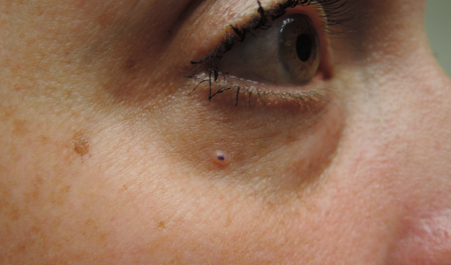 skin cancer, lower eyelid basal cell carcinoma, basal cell carcinoma, dermatology, mohs surgery